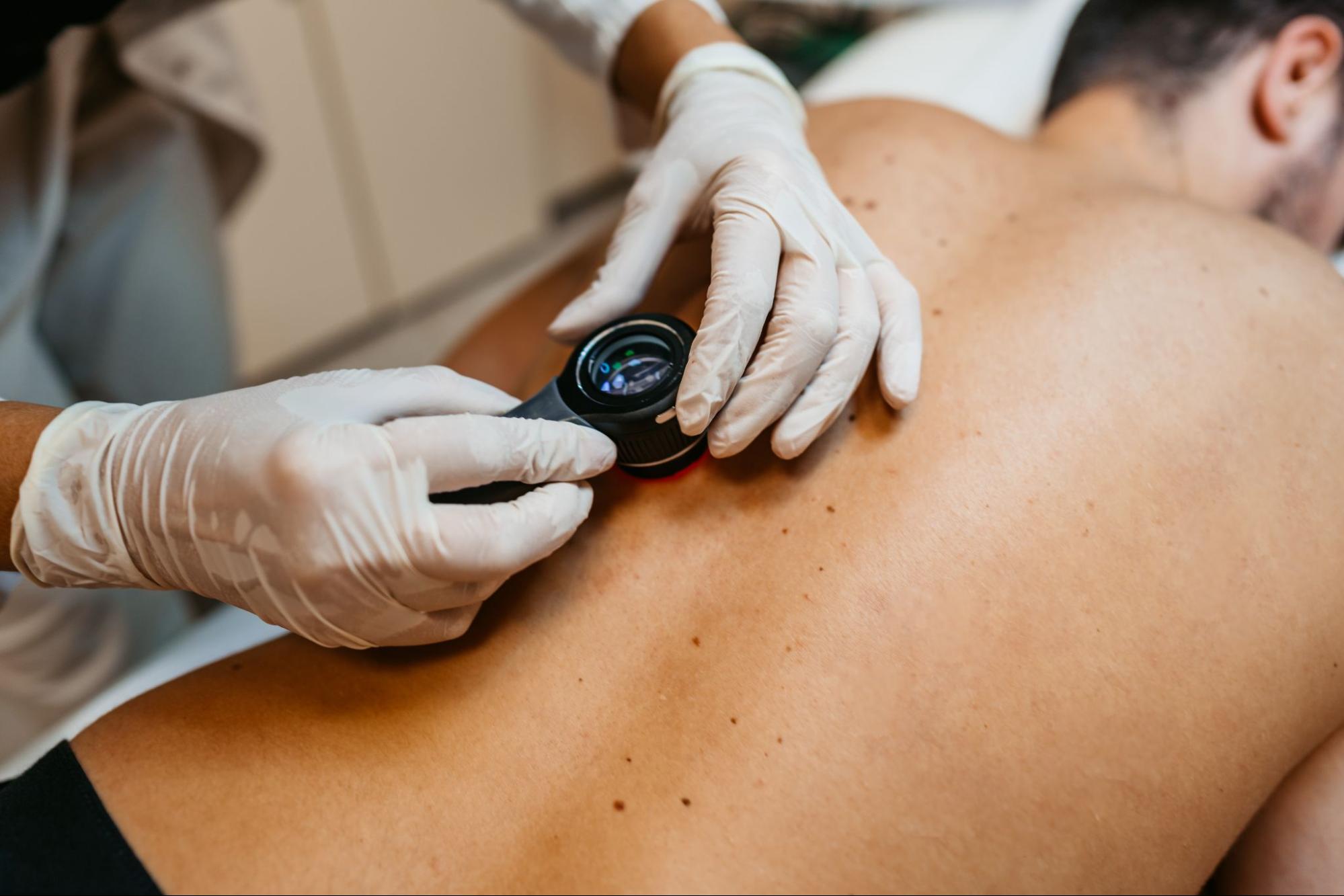 Benefits of Regular Skin Screenings To Catch Skin Cancer Early