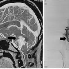 Neuroradiology’s Role in Diagnosing and Managing Brain Infections