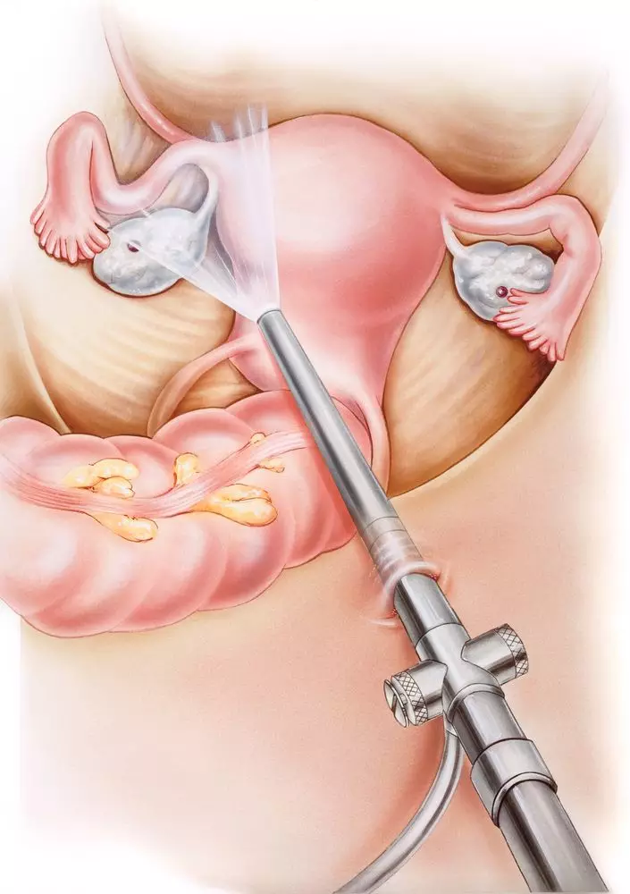What You Need To Know About Post-colonoscopy Care