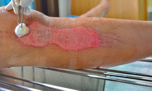 How to Properly Clean and Care for Wounds to Avoid Infection