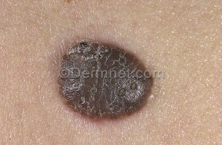 Exploring Treatment Options for Seborrheic Keratosis