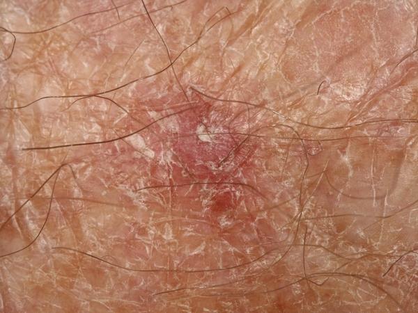 Diet and Lifestyle Changes To Support Recovery After Mohs Skin Cancer Surgery