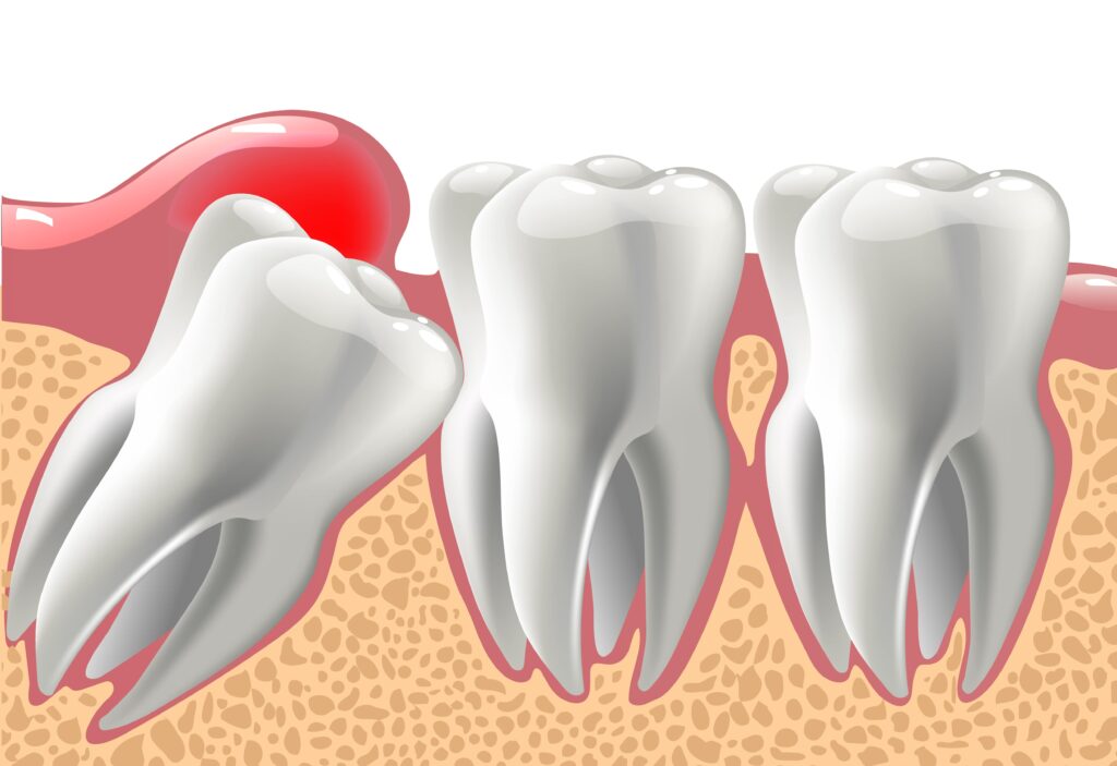 How Tooth Extractions Can Lead To Better Oral Health Outcomes