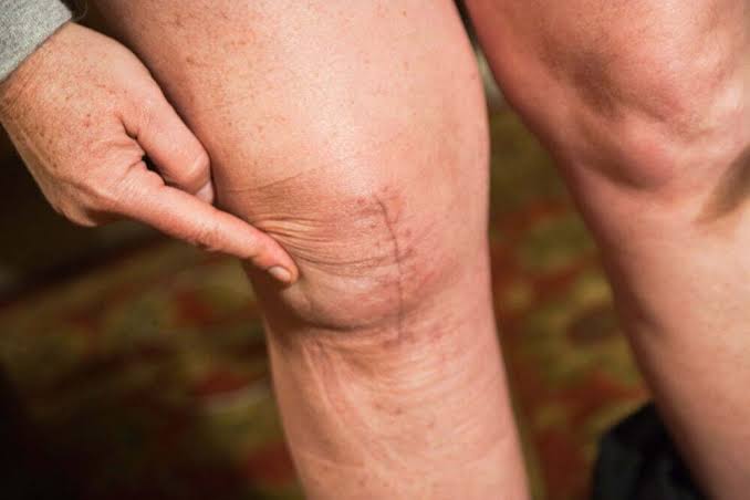 Preparing for Joint Replacement Surgery