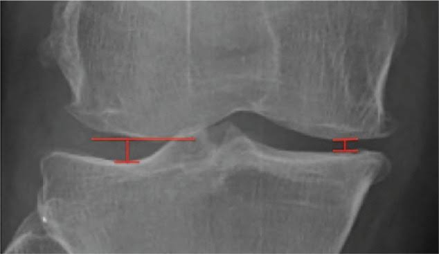 Questions To Ask Your Osteoarthritis Doctor