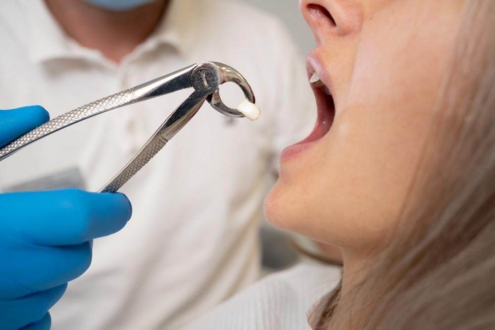 Root Canal Treatment and Aftercare Explained