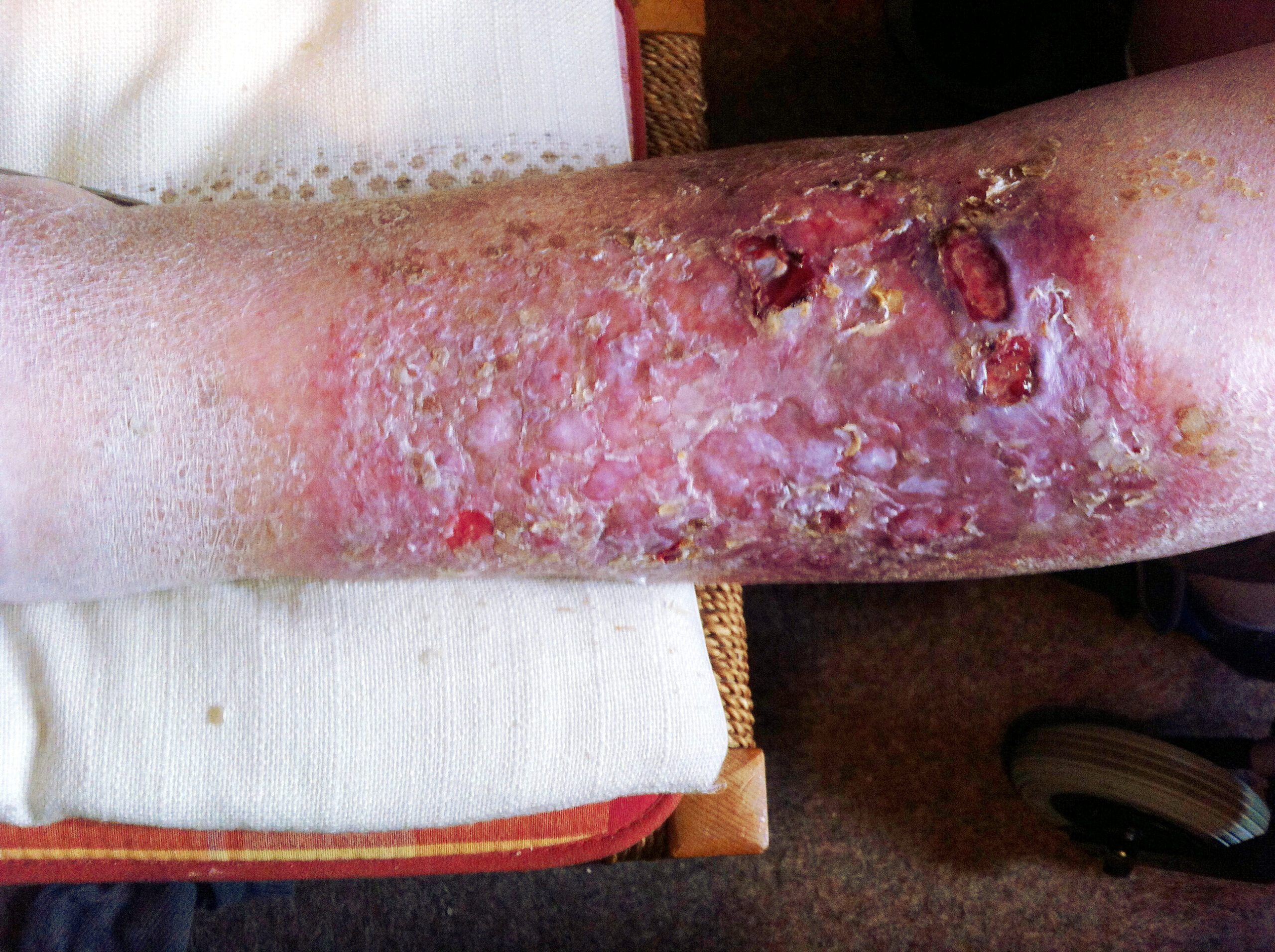 Symptoms, Diagnosis, and Management Options for Chronic Venous Insufficiency