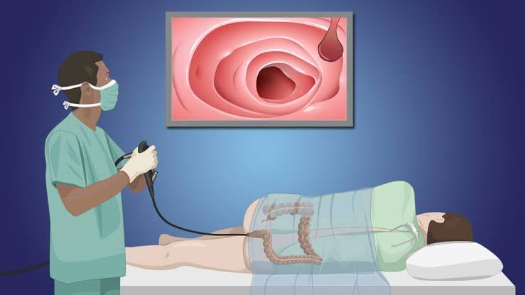 Tips for Understanding the Colonoscopy Process