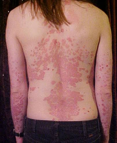 Treatments for Skin Allergy Symptoms