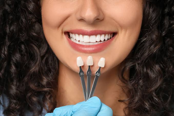 Understanding Whether Veneers Are Right for Your Needs