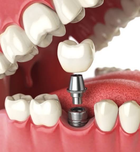 What To Know About Cosmetic Dental Implants