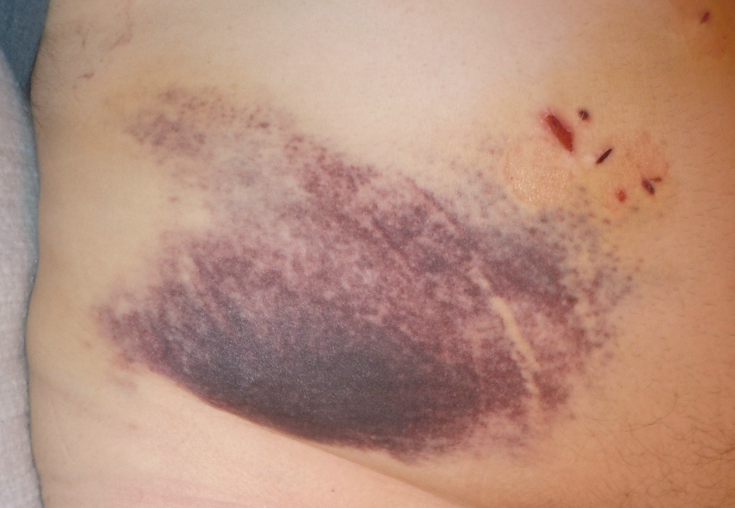 What To Know About Gallbladder Removal Surgery